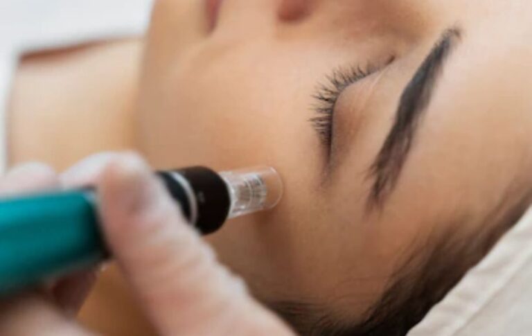 Workshop de Microagulhamento